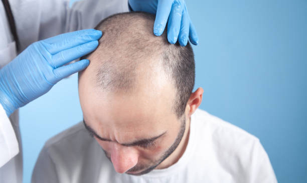 Hair Transplant Treatment at BR Healthcare