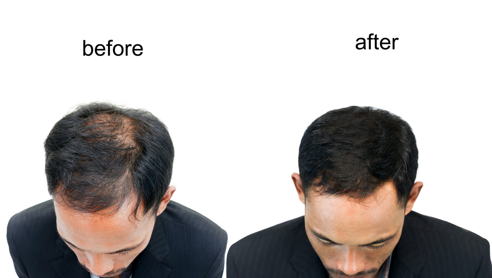 Hair Transplant Treatment at BR Healthcare