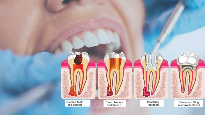 Advanced root canal at BR healthcare